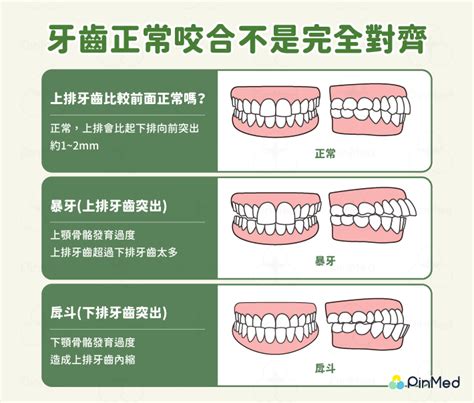 上下排牙齒平行 會窮